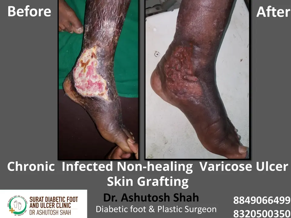 Varicose veins and Ulcers.pptx-6.webp